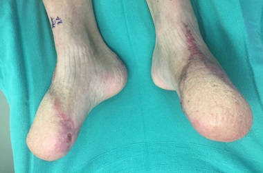 post-surgical limb salvage after